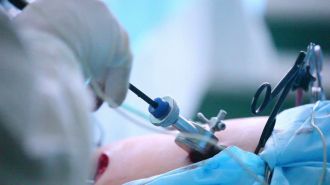 Врачи ФМБЦ им. А.И. Бурназяна ФМБА России провели операцию по удалению желчного пузыря и маточной трубы методом single port