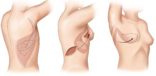 Руководитель группы реконструктивной и пластической хирургии к.м.н. В.А. Аксененко провел четыре показательных одномоментных реконструкции молочных желез с использованием торакадозального лоскута на конференции в Нижнем Новогороде.