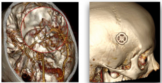 Нейрохирурги ФМБЦ им.А.И. Бурназяна первыми в мире клипировали аневризму артерии головного мозга через минимальный доступ, размером всего в 14 мм