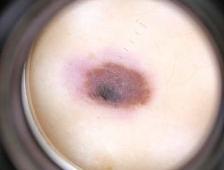 С 1по 30 июня в ФМБЦ им. А.И. Бурназяна можно пройти бесплатную диагностику новообразований кожи.