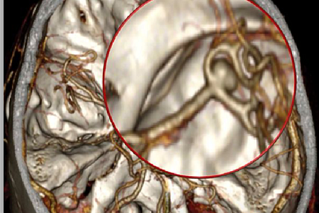 Нейрохирурги ФМБЦ им.А.И. Бурназяна первыми в мире клипировали аневризму артерии головного мозга через минимальный доступ, размером всего в 14 мм