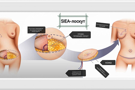 РЕКОНСТРУКТИВНАЯ ХИРУРГИЯ МОЛОЧНОЙ ЖЕЛЕЗЫ В ФМБЦ ИМ.А.И. БУРНАЗЯНА