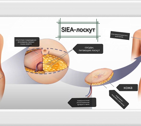 РЕКОНСТРУКТИВНАЯ ХИРУРГИЯ МОЛОЧНОЙ ЖЕЛЕЗЫ В ФМБЦ ИМ.А.И. БУРНАЗЯНА