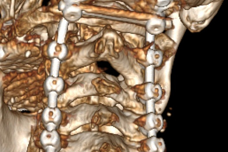 Нейрохирурги ФМБЦ им. А.И. Бурназяна «отсоединили» голову от шеи, чтобы удалить разрушенный онкопроцессом шейный позвонок