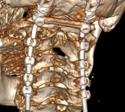 Нейрохирурги ФМБЦ им. А.И. Бурназяна «отсоединили» голову от шеи, чтобы удалить разрушенный онкопроцессом шейный позвонок