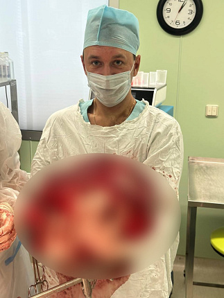 Хирурги ФМБЦ им.А.И. Бурназяна ФМБА России удалили гигантскую липосаркому
