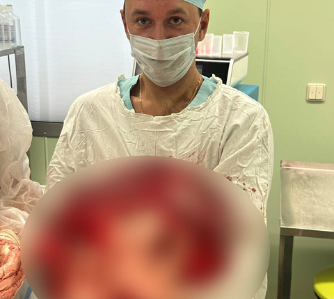 Хирурги ФМБЦ им.А.И. Бурназяна ФМБА России удалили гигантскую липосаркому