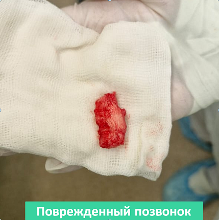 Нейрохирурги ФМБЦ им. А.И. Бурназяна «отсоединили» голову от шеи, чтобы удалить разрушенный онкопроцессом шейный позвонок
