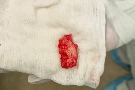 Нейрохирурги ФМБЦ им. А.И. Бурназяна «отсоединили» голову от шеи, чтобы удалить разрушенный онкопроцессом шейный позвонок