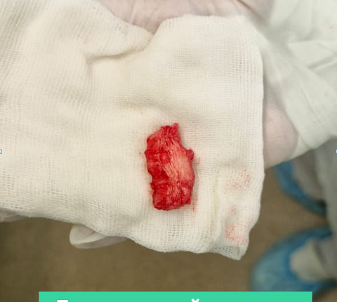 Нейрохирурги ФМБЦ им. А.И. Бурназяна «отсоединили» голову от шеи, чтобы удалить разрушенный онкопроцессом шейный позвонок