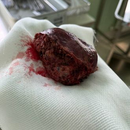 8-сантиметровую опухоль печени удалили хирурги ФМБЦ им. А.И. Бурназяна