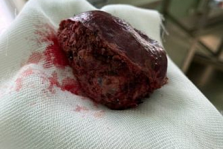 8-сантиметровую опухоль печени удалили хирурги ФМБЦ им. А.И. Бурназяна