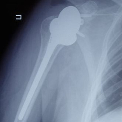 Врачи травматолого-ортопедического отделения ФМБЦ им. А.И. Бурназяна ФМБА России впервые выполнили реверсивное эндопротезирование плеча