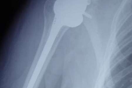 Врачи травматолого-ортопедического отделения ФМБЦ им. А.И. Бурназяна ФМБА России впервые выполнили реверсивное эндопротезирование плеча