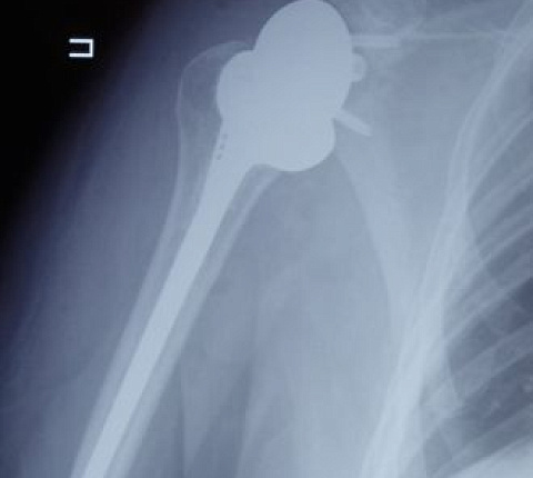 Врачи травматолого-ортопедического отделения ФМБЦ им. А.И. Бурназяна ФМБА России впервые выполнили реверсивное эндопротезирование плеча