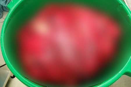 Хирурги ФМБЦ им.А.И. Бурназяна ФМБА России удалили гигантскую липосаркому