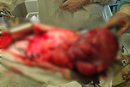 Хирурги ФМБЦ им.А. И. Бурназяна удалили опухоль весом почти в 20 кг