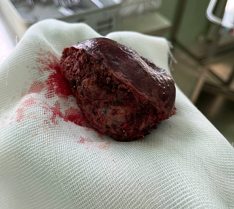 8-сантиметровую опухоль печени удалили хирурги ФМБЦ им. А.И. Бурназяна