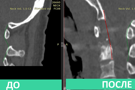 Нейрохирурги ФМБЦ им. А.И. Бурназяна «отсоединили» голову от шеи, чтобы удалить разрушенный онкопроцессом шейный позвонок