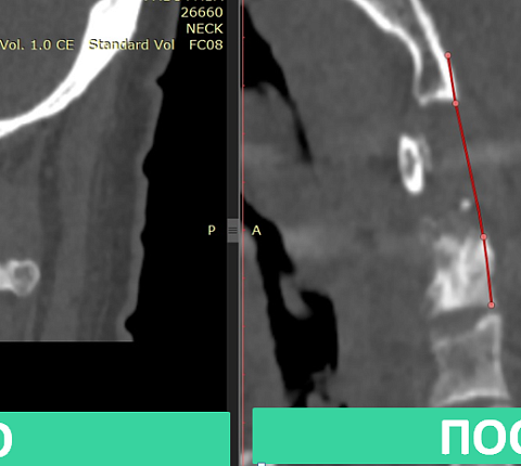 Нейрохирурги ФМБЦ им. А.И. Бурназяна «отсоединили» голову от шеи, чтобы удалить разрушенный онкопроцессом шейный позвонок
