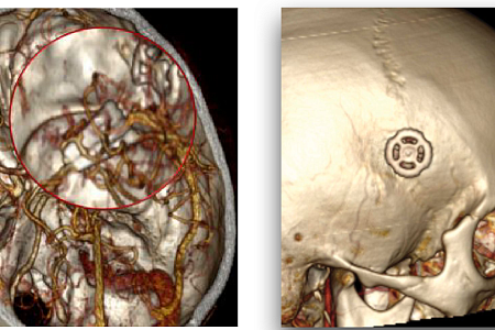 Нейрохирурги ФМБЦ им.А.И. Бурназяна первыми в мире клипировали аневризму артерии головного мозга через минимальный доступ, размером всего в 14 мм