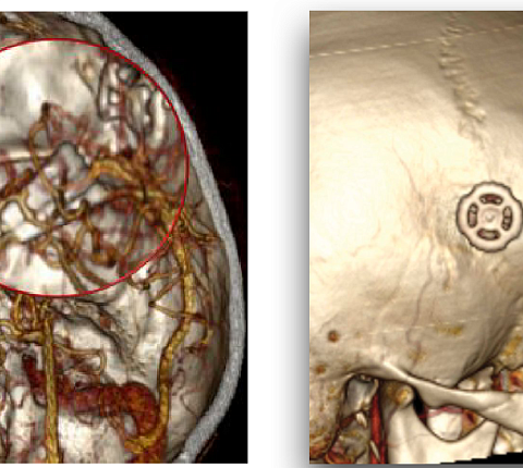 Нейрохирурги ФМБЦ им.А.И. Бурназяна первыми в мире клипировали аневризму артерии головного мозга через минимальный доступ, размером всего в 14 мм