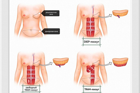 РЕКОНСТРУКТИВНАЯ ХИРУРГИЯ МОЛОЧНОЙ ЖЕЛЕЗЫ В ФМБЦ ИМ.А.И. БУРНАЗЯНА