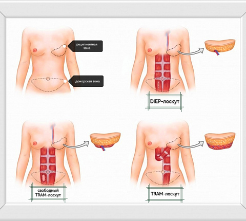 РЕКОНСТРУКТИВНАЯ ХИРУРГИЯ МОЛОЧНОЙ ЖЕЛЕЗЫ В ФМБЦ ИМ.А.И. БУРНАЗЯНА