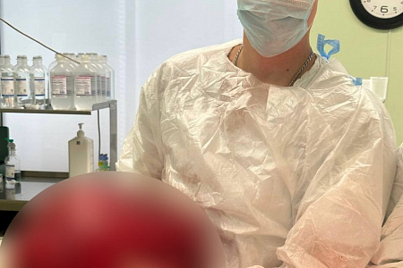 Хирурги ФМБЦ им.А.И. Бурназяна ФМБА России удалили гигантскую липосаркому