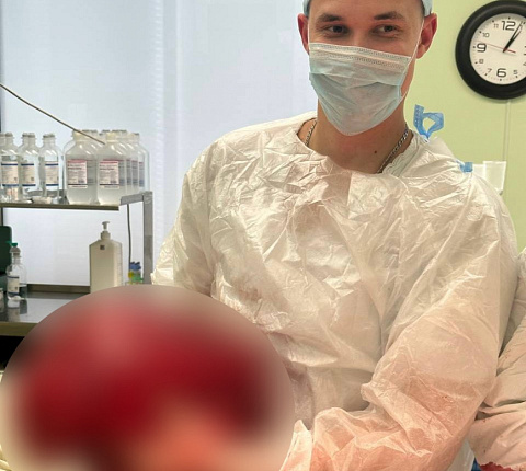 Хирурги ФМБЦ им.А.И. Бурназяна ФМБА России удалили гигантскую липосаркому